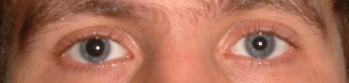 does unequal pupil size mean pink eye