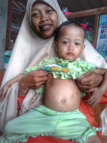 A child with measles in Indonesia.