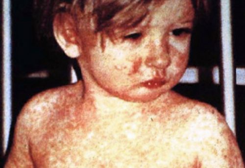 Child with Measles rash.
