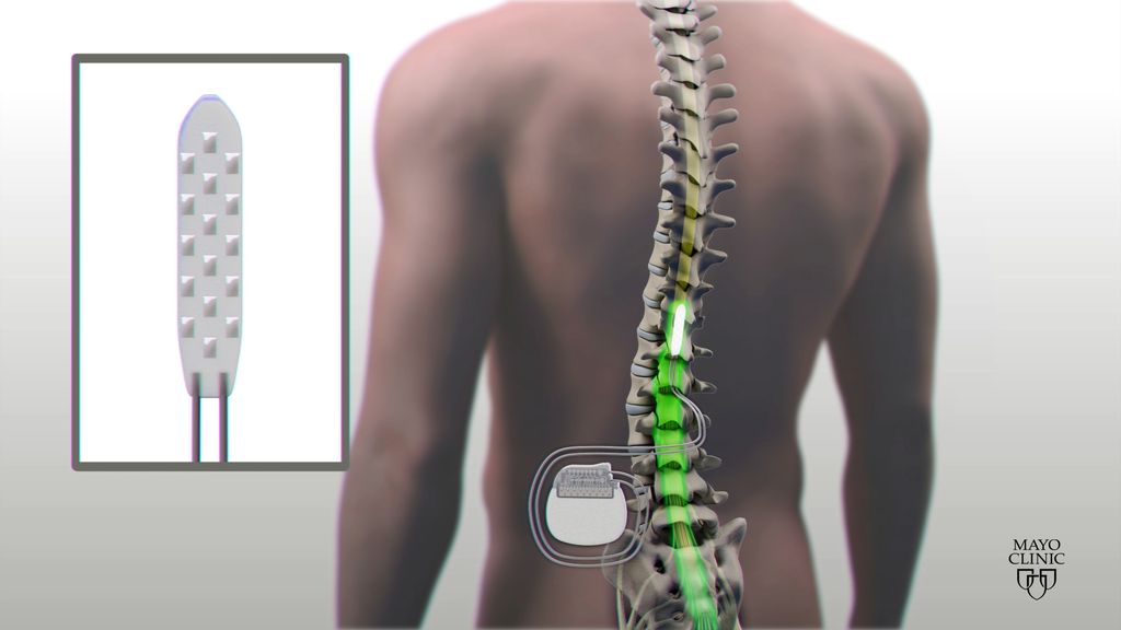 Illustration showing location of spinal implant.