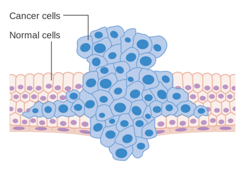 Diagram showing a tumor forcing its way through normal tissues.