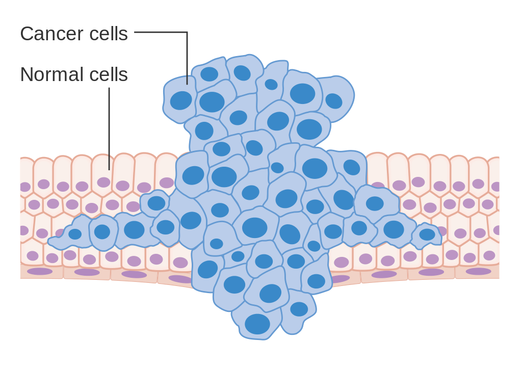 Diagram showing a tumor forcing its way through normal tissues.
