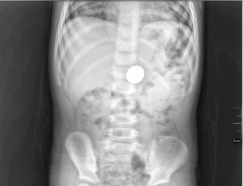 X-ray showing a swallowed coin.