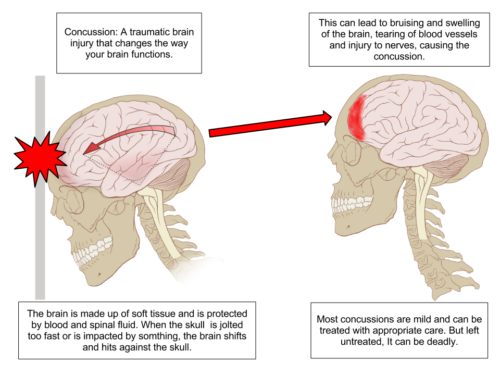 Concussion Diagram