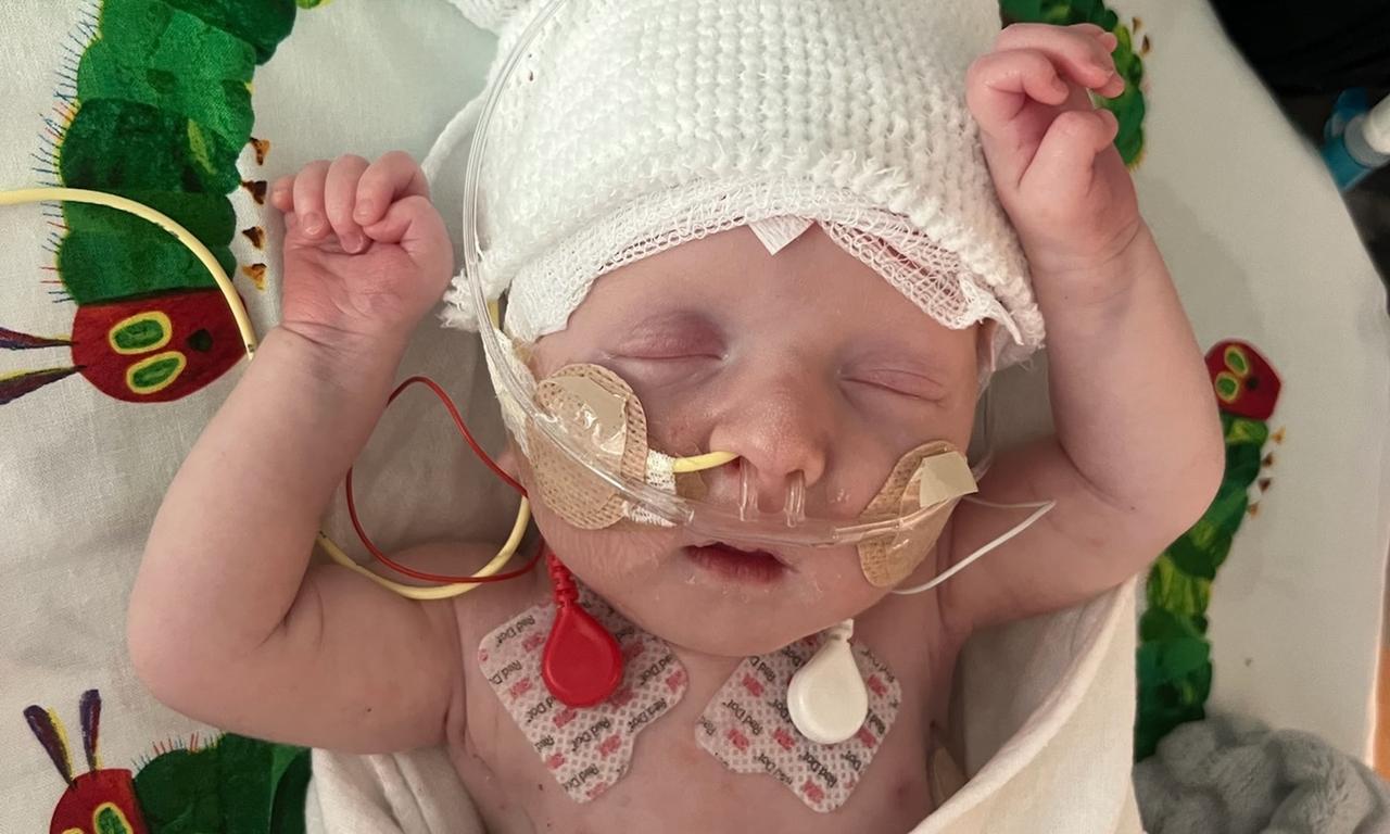 Head and chest of a frail-looking sleeping young infant with multiple tubes going into his nose and sensors on his chest.